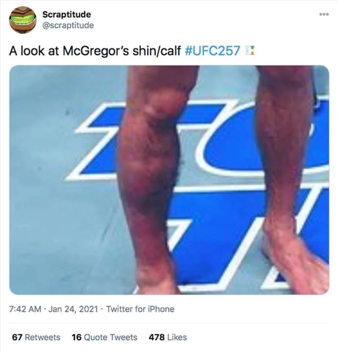 Hình ảnh cái chân của McGregor sau thất bại trước Poirier.